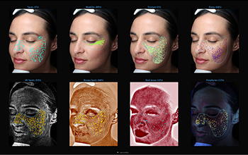 VISIA Advanced Skin Analysis Machine - measuring skin concerns