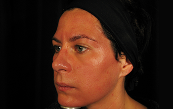 Collagen Induction Therapy results slide 3