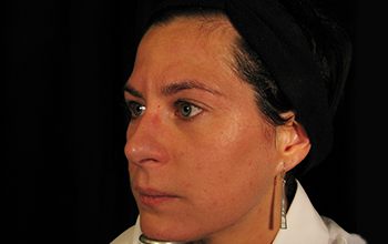 Collagen Induction Therapy results slide 4