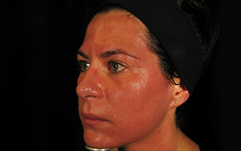 Collagen Induction Therapy results slide 2