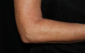 Arm after