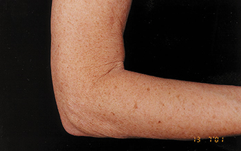 Arm before