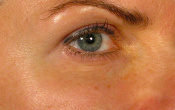Eyes after