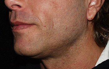 Face after